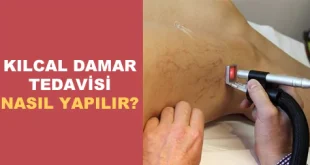 kılcal damar tedavisi nasıl yapılır