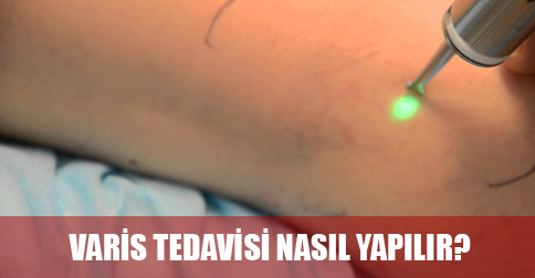 varis tedavisi nasıl yapılır