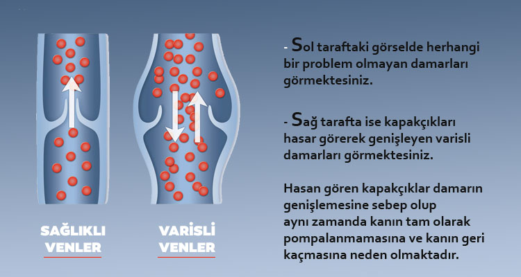 sağlıklı ve varisli damarlar