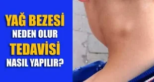 yağ bezesi nasıl geçer