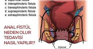 anal fistül tedavisi