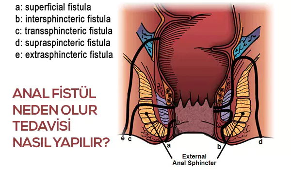 anal fistül tedavisi