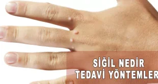 siğil tedavisi