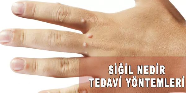 siğil tedavisi