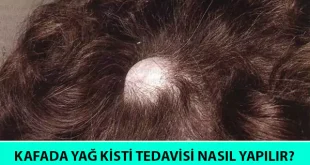 kafada yağ kisti tedavisi