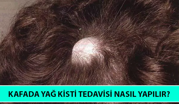 kafada yağ kisti tedavisi