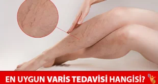 varis tedavisi yöntemleri